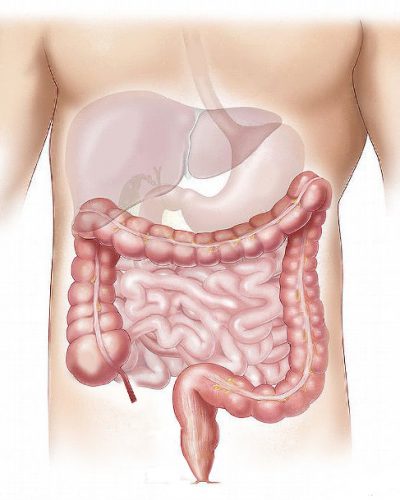 Cancer de colon
